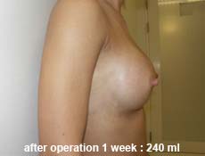 plastic-surgery-breast-augmentation 